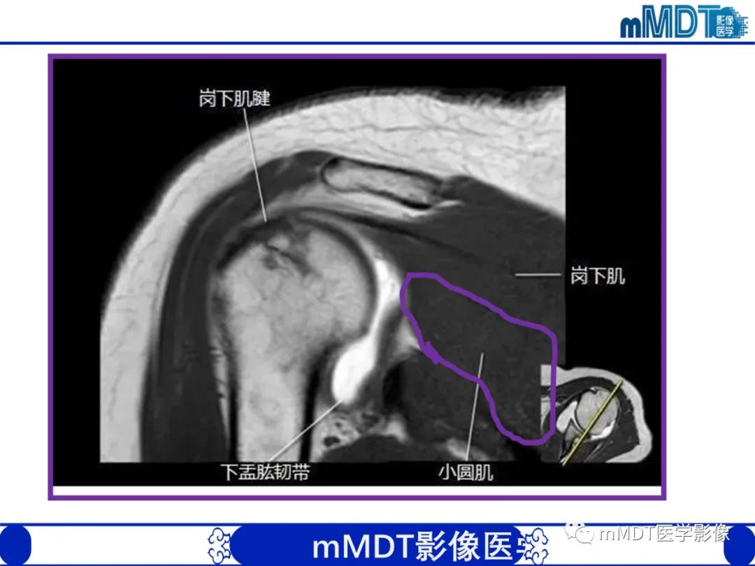 影像PPT - 【PPT】肩关节撞击综合征-30