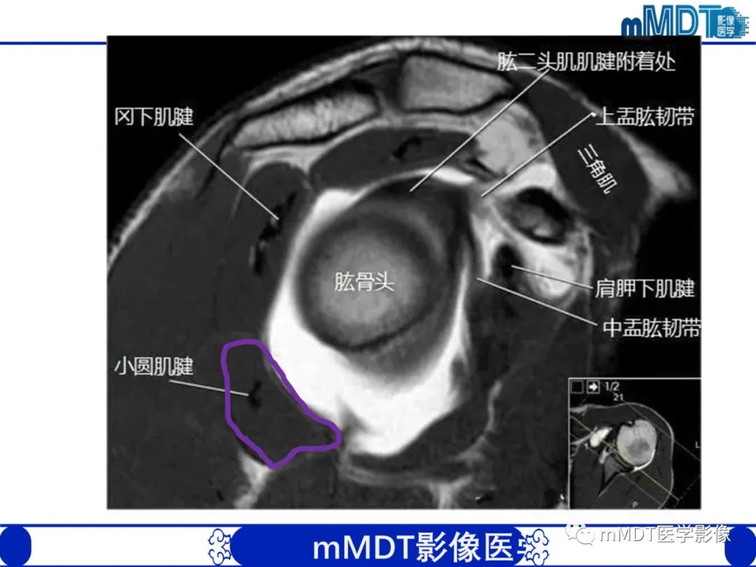 影像PPT - 【PPT】肩关节撞击综合征-31