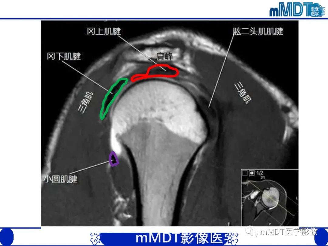 影像PPT - 【PPT】肩关节撞击综合征-35