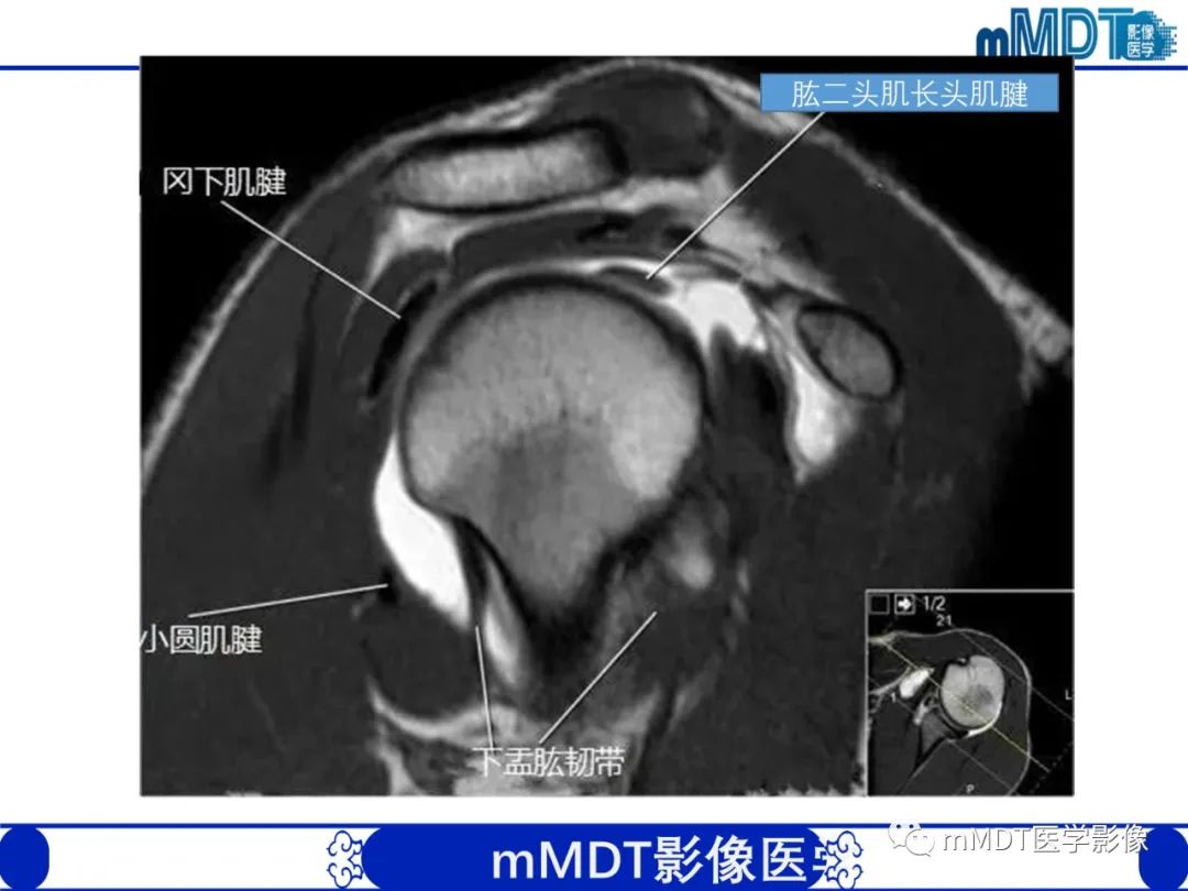 影像PPT - 【PPT】肩关节撞击综合征-36