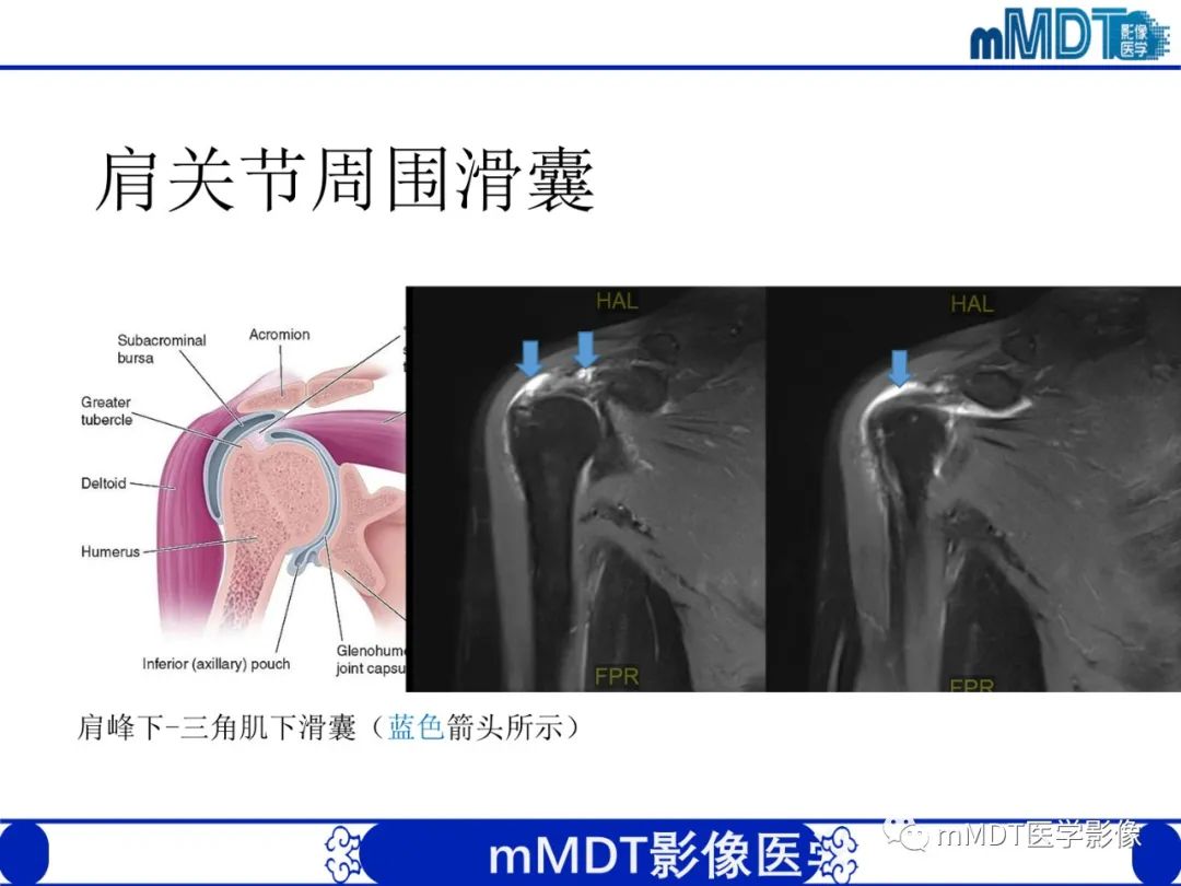 影像PPT - 【PPT】肩关节撞击综合征-37