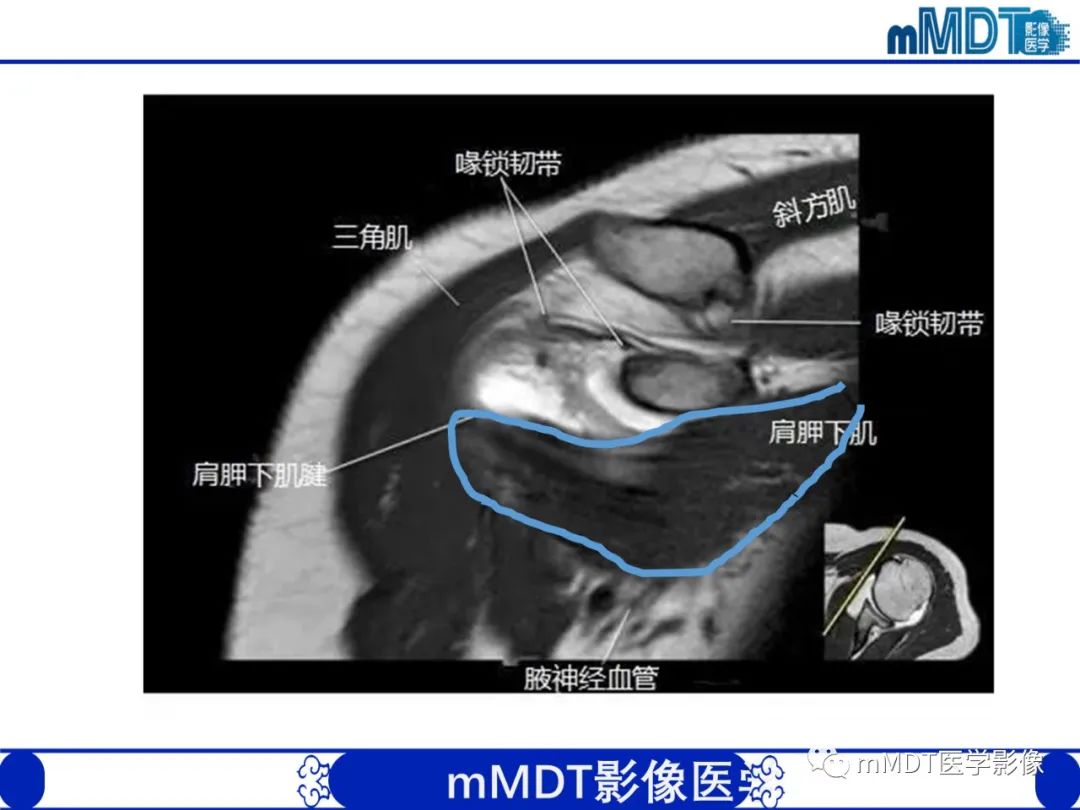 影像PPT - 【PPT】肩关节撞击综合征-33
