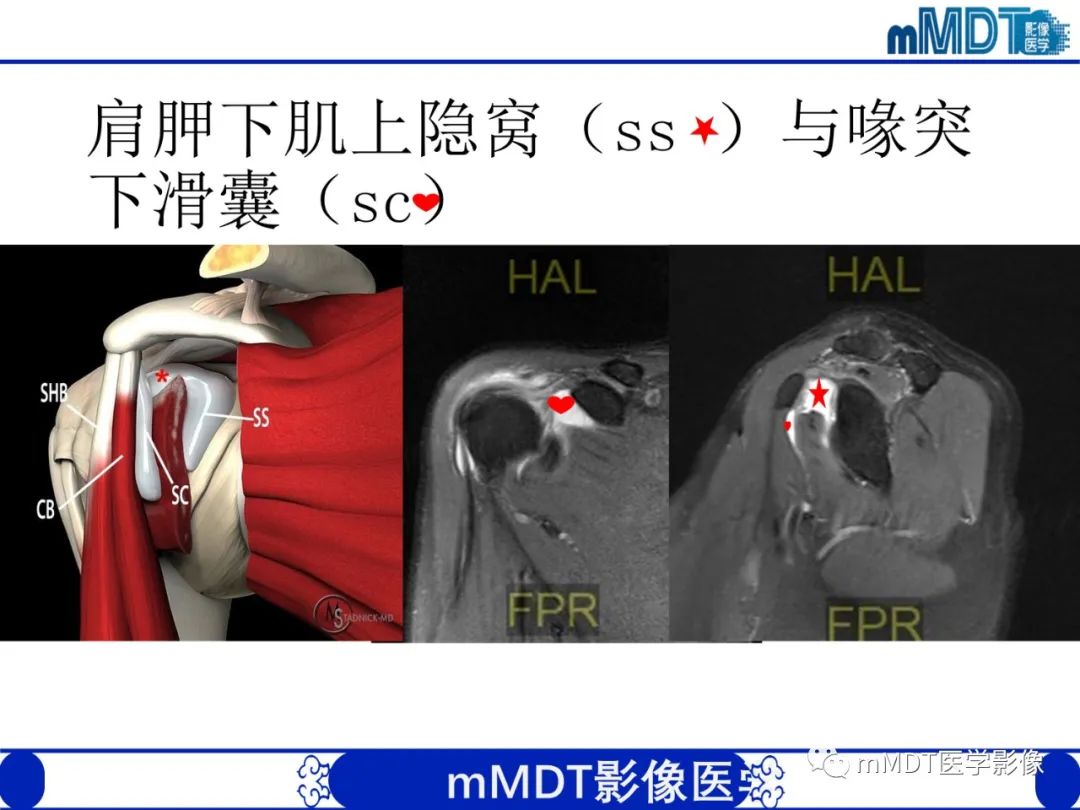 影像PPT - 【PPT】肩关节撞击综合征-38