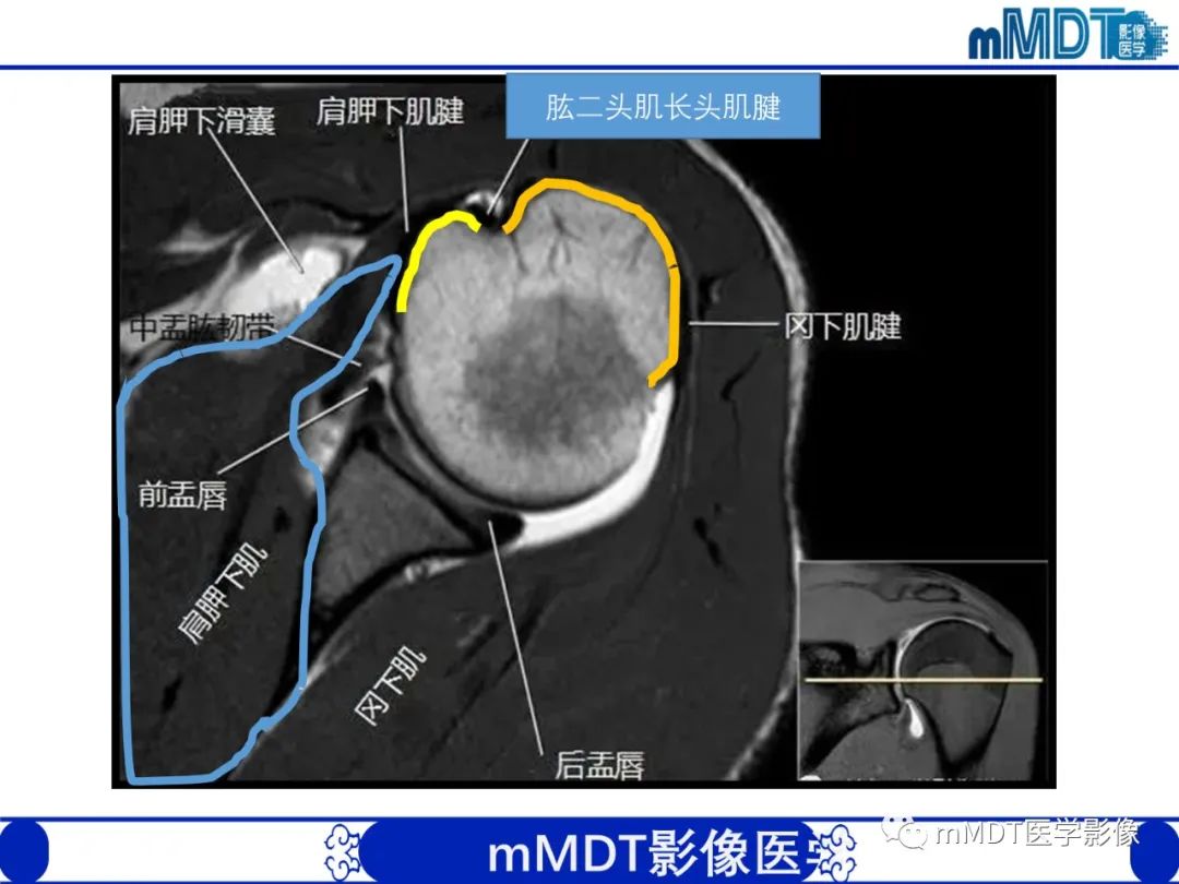 影像PPT - 【PPT】肩关节撞击综合征-34