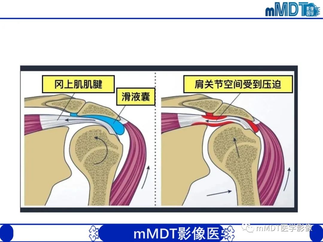 影像PPT - 【PPT】肩关节撞击综合征-41