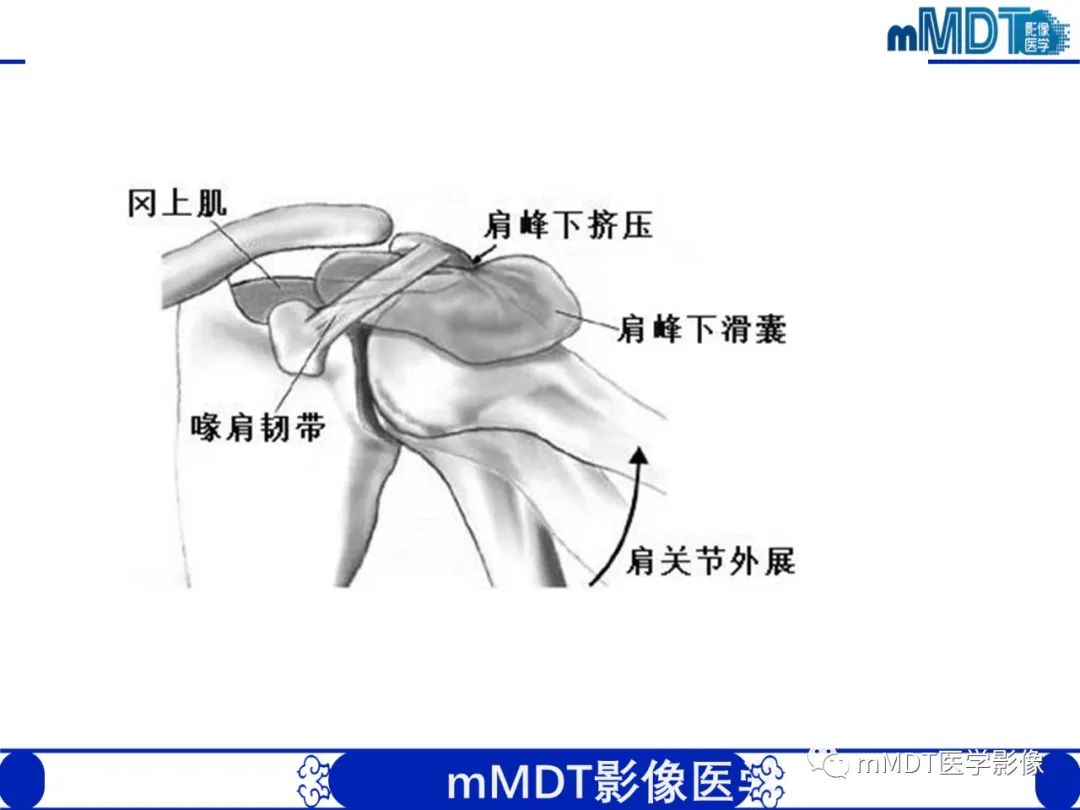 影像PPT - 【PPT】肩关节撞击综合征-42