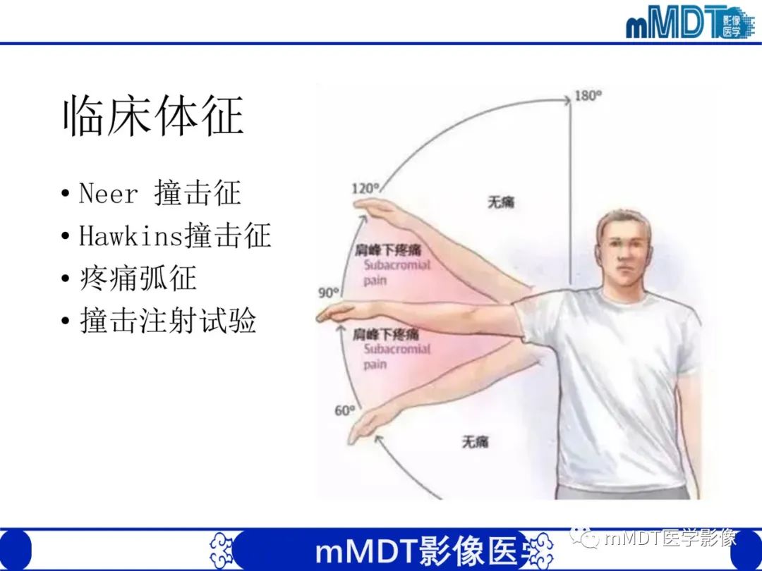影像PPT - 【PPT】肩关节撞击综合征-45