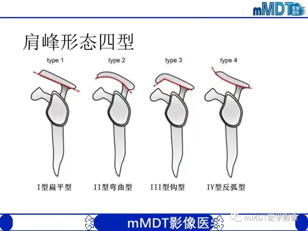 影像PPT - 【PPT】肩关节撞击综合征-49