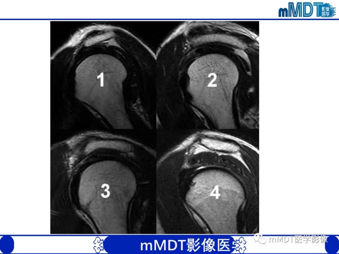 影像PPT - 【PPT】肩关节撞击综合征-50