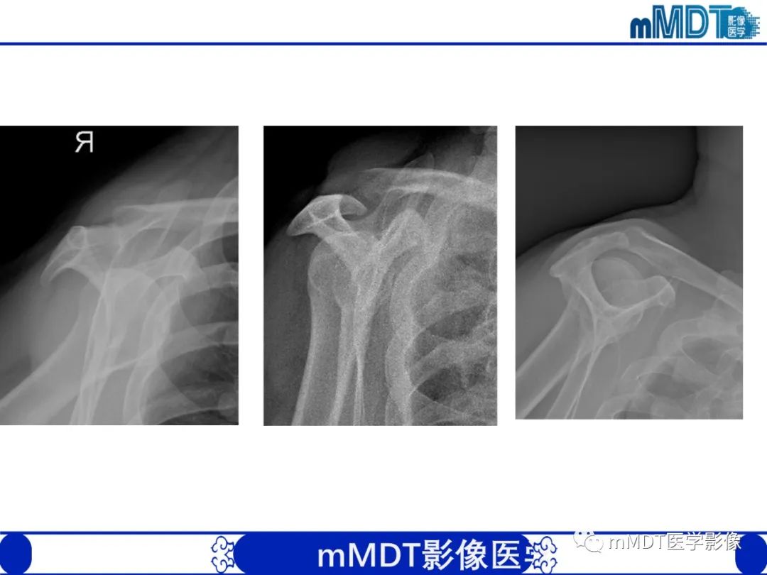 影像PPT - 【PPT】肩关节撞击综合征-51