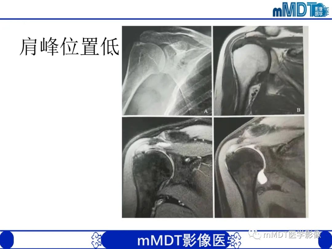 影像PPT - 【PPT】肩关节撞击综合征-52