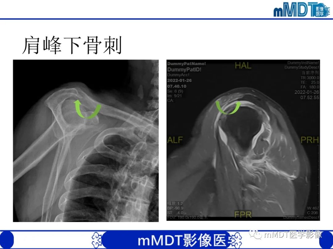 影像PPT - 【PPT】肩关节撞击综合征-53