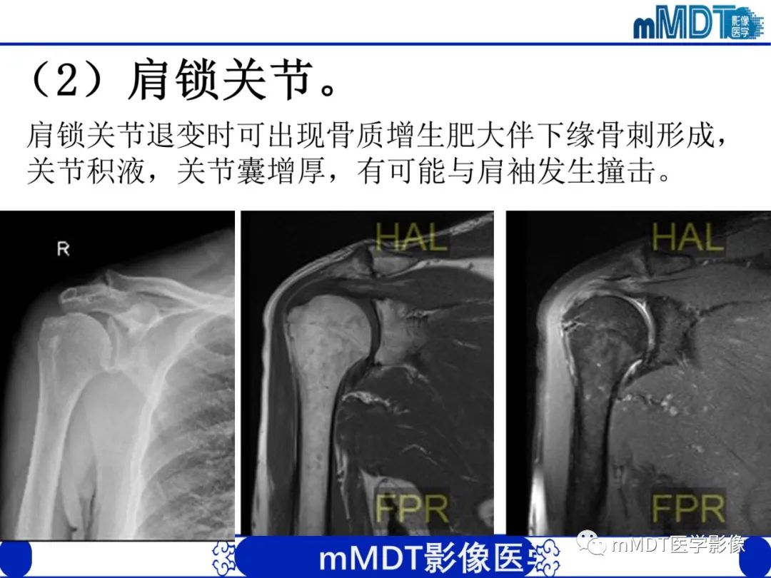 影像PPT - 【PPT】肩关节撞击综合征-54