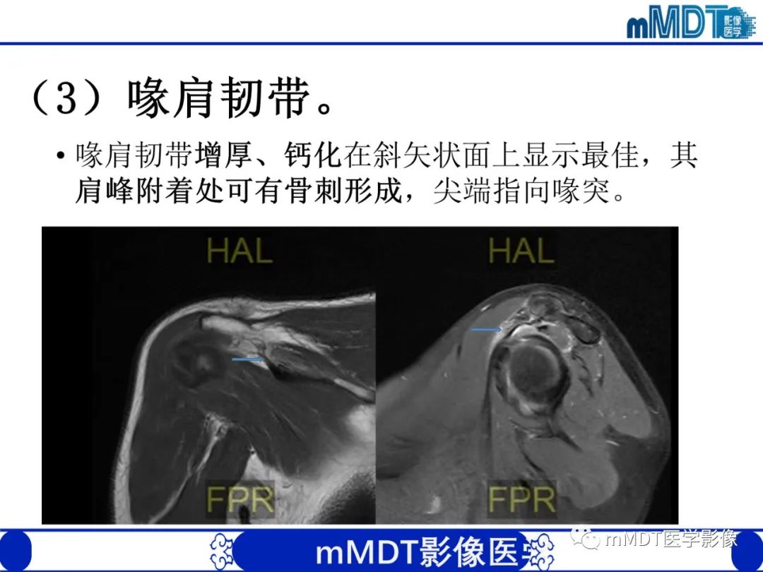 影像PPT - 【PPT】肩关节撞击综合征-56