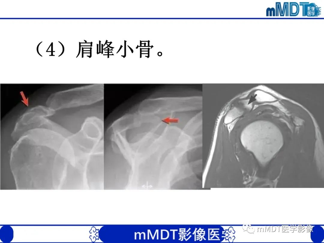 影像PPT - 【PPT】肩关节撞击综合征-58
