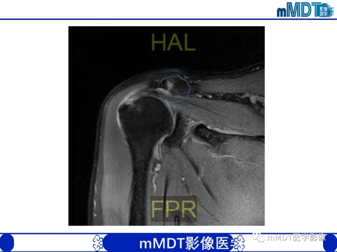 影像PPT - 【PPT】肩关节撞击综合征-55