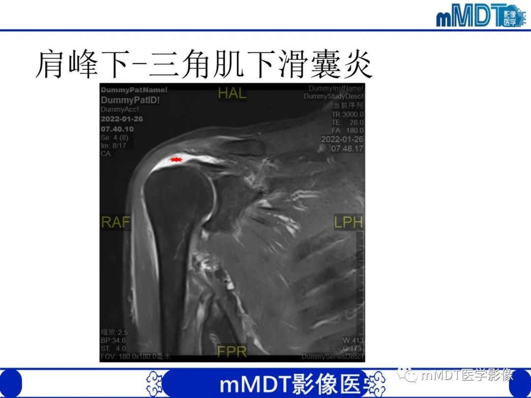 影像PPT - 【PPT】肩关节撞击综合征-63