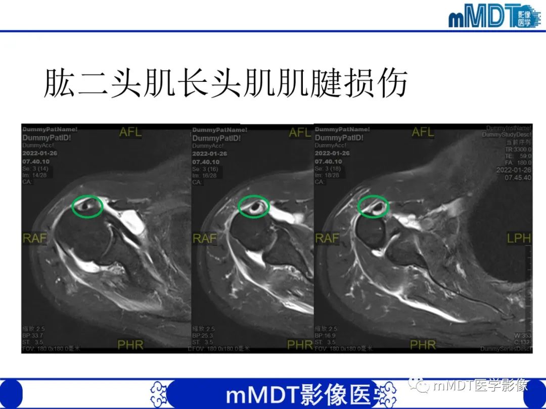 影像PPT - 【PPT】肩关节撞击综合征-64