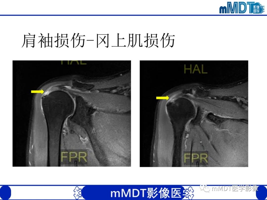 影像PPT - 【PPT】肩关节撞击综合征-62