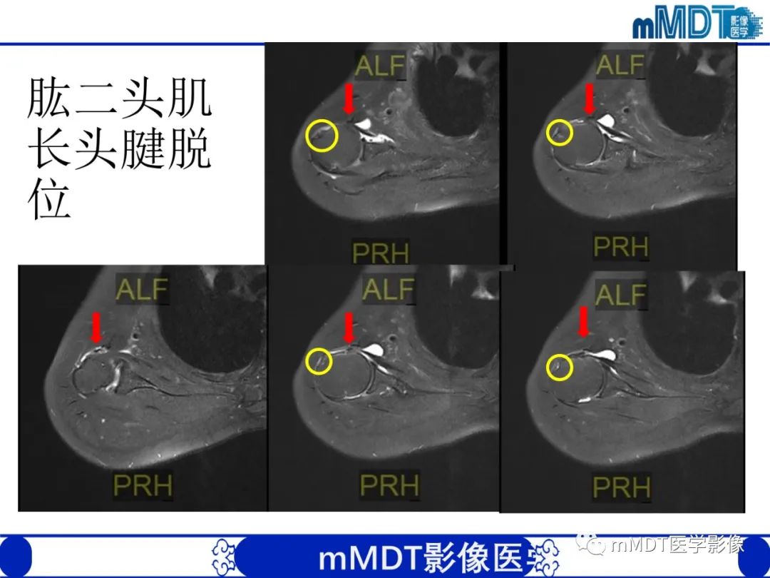 影像PPT - 【PPT】肩关节撞击综合征-65