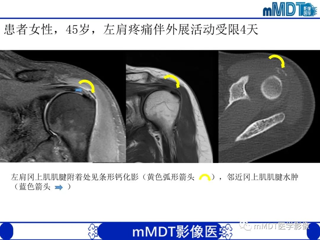 影像PPT - 【PPT】肩关节撞击综合征-70