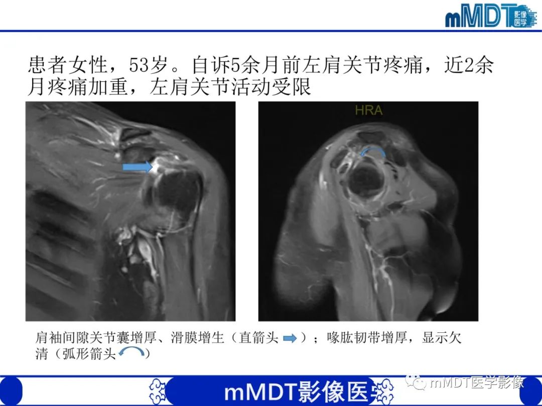 影像PPT - 【PPT】肩关节撞击综合征-72