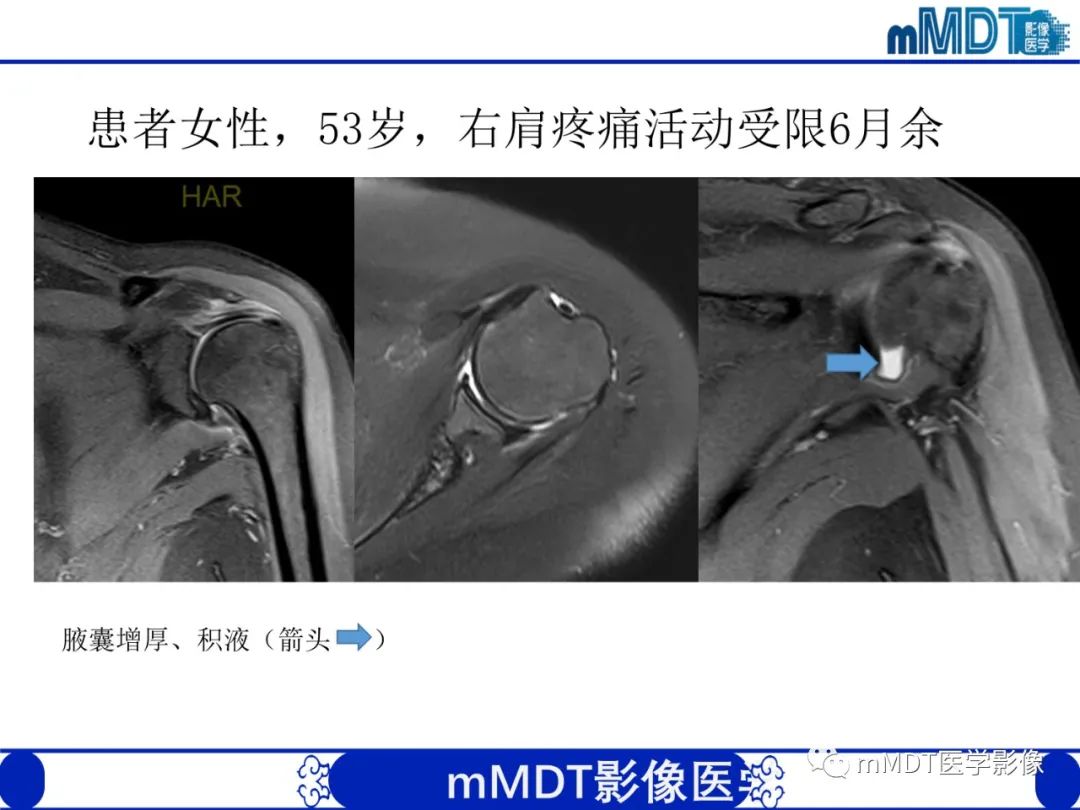 影像PPT - 【PPT】肩关节撞击综合征-73