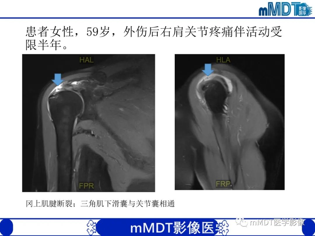 影像PPT - 【PPT】肩关节撞击综合征-75