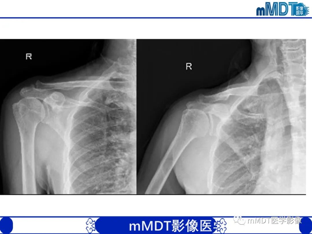影像PPT - 【PPT】肩关节撞击综合征-78