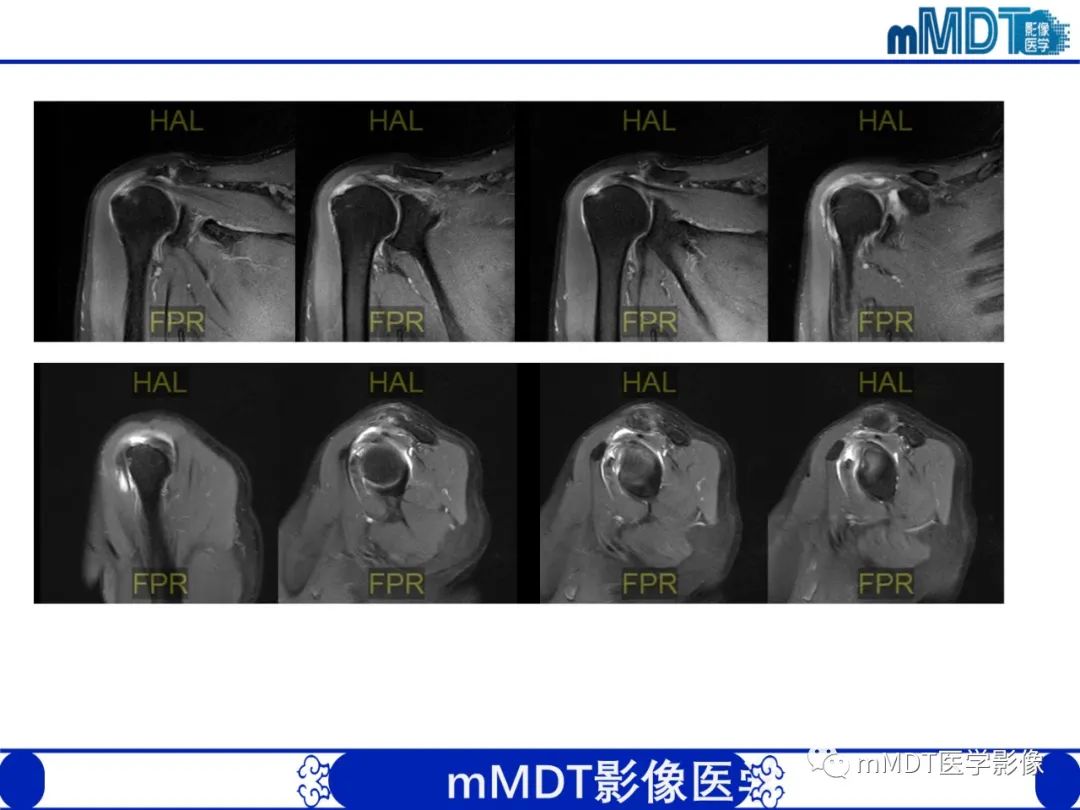 影像PPT - 【PPT】肩关节撞击综合征-79