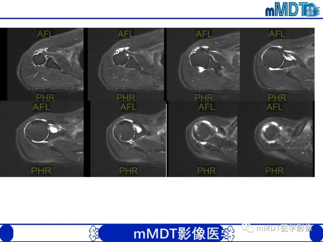 影像PPT - 【PPT】肩关节撞击综合征-80