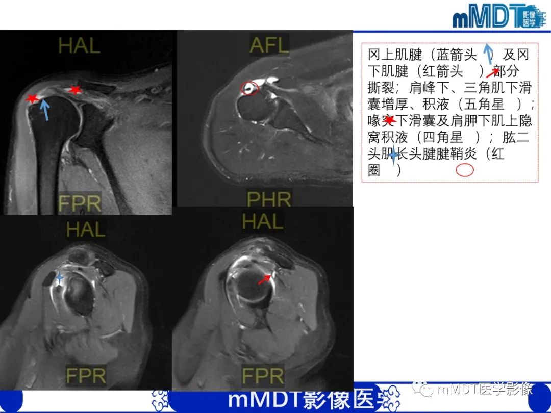 影像PPT - 【PPT】肩关节撞击综合征-81