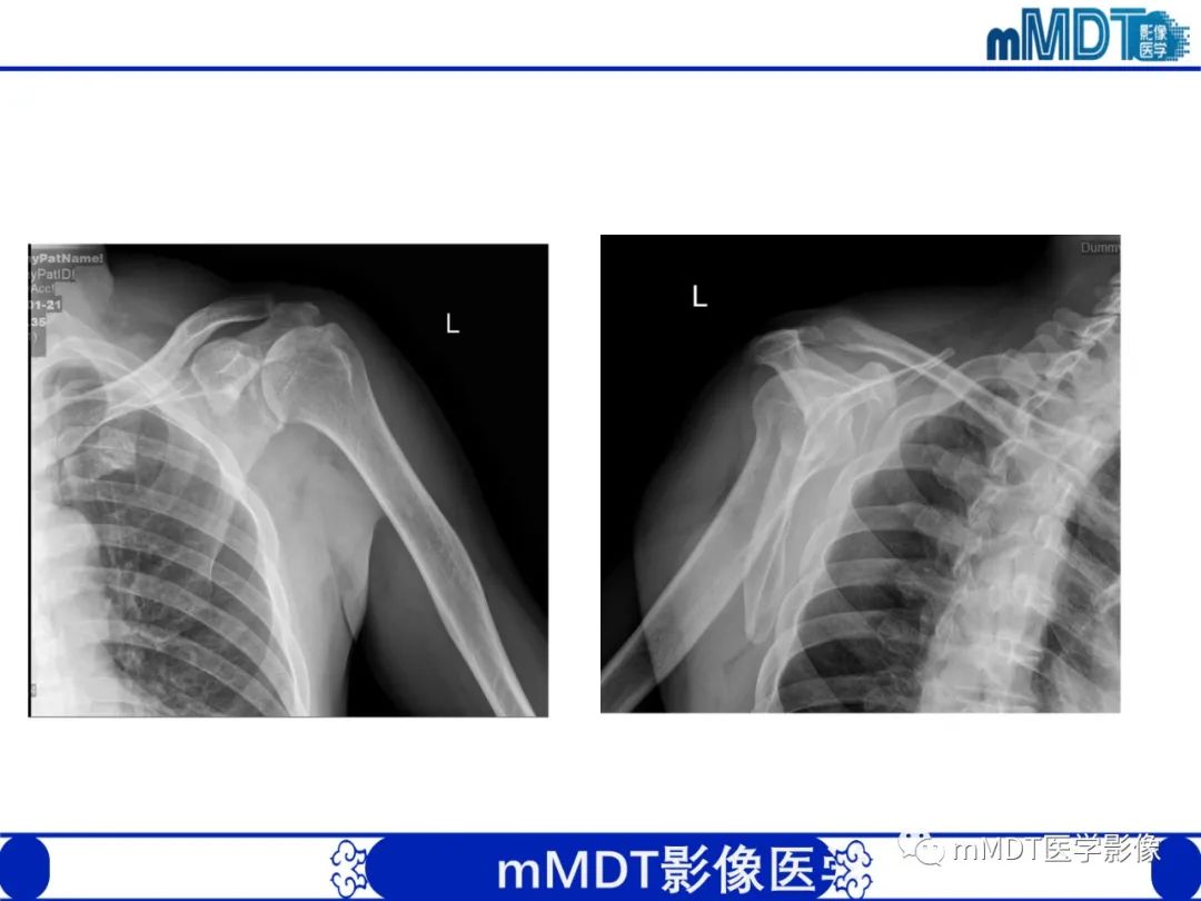 影像PPT - 【PPT】肩关节撞击综合征-85