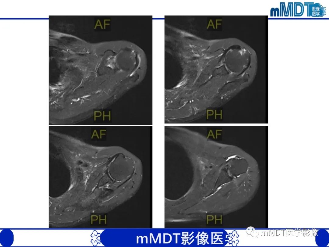 影像PPT - 【PPT】肩关节撞击综合征-86