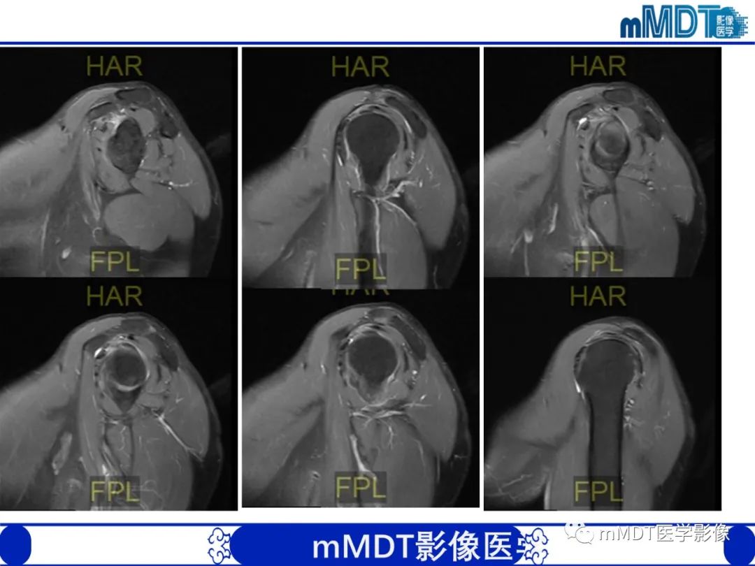 影像PPT - 【PPT】肩关节撞击综合征-88