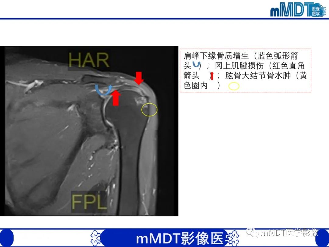 影像PPT - 【PPT】肩关节撞击综合征-89