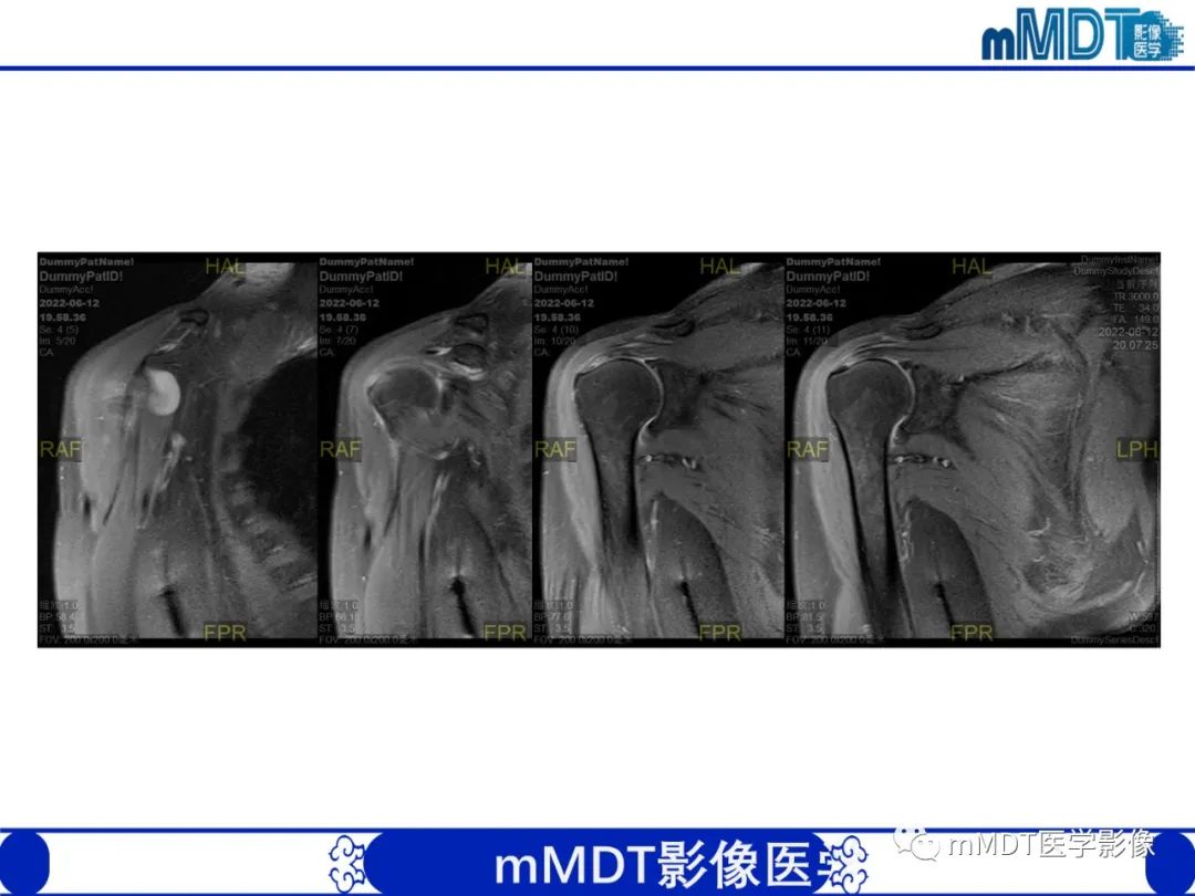 影像PPT - 【PPT】肩关节撞击综合征-94