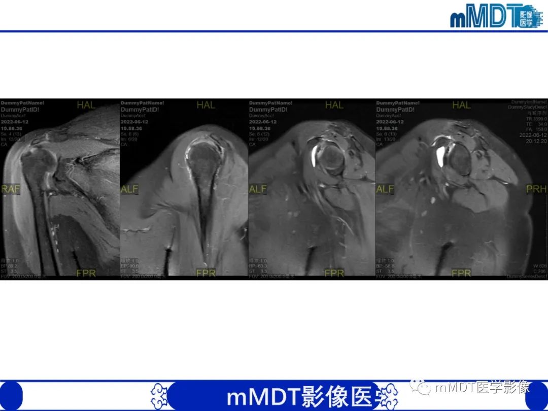 影像PPT - 【PPT】肩关节撞击综合征-95