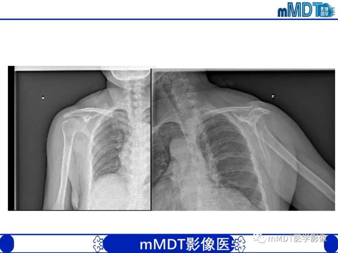 影像PPT - 【PPT】肩关节撞击综合征-93