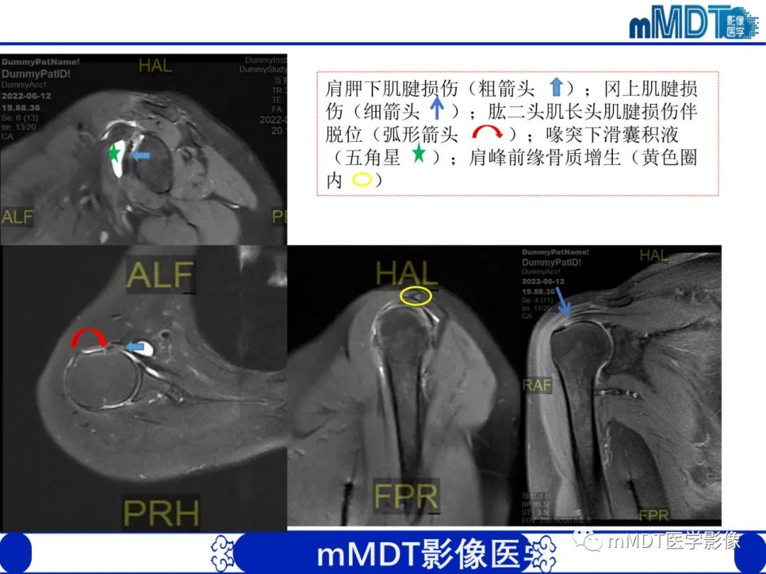 影像PPT - 【PPT】肩关节撞击综合征-97