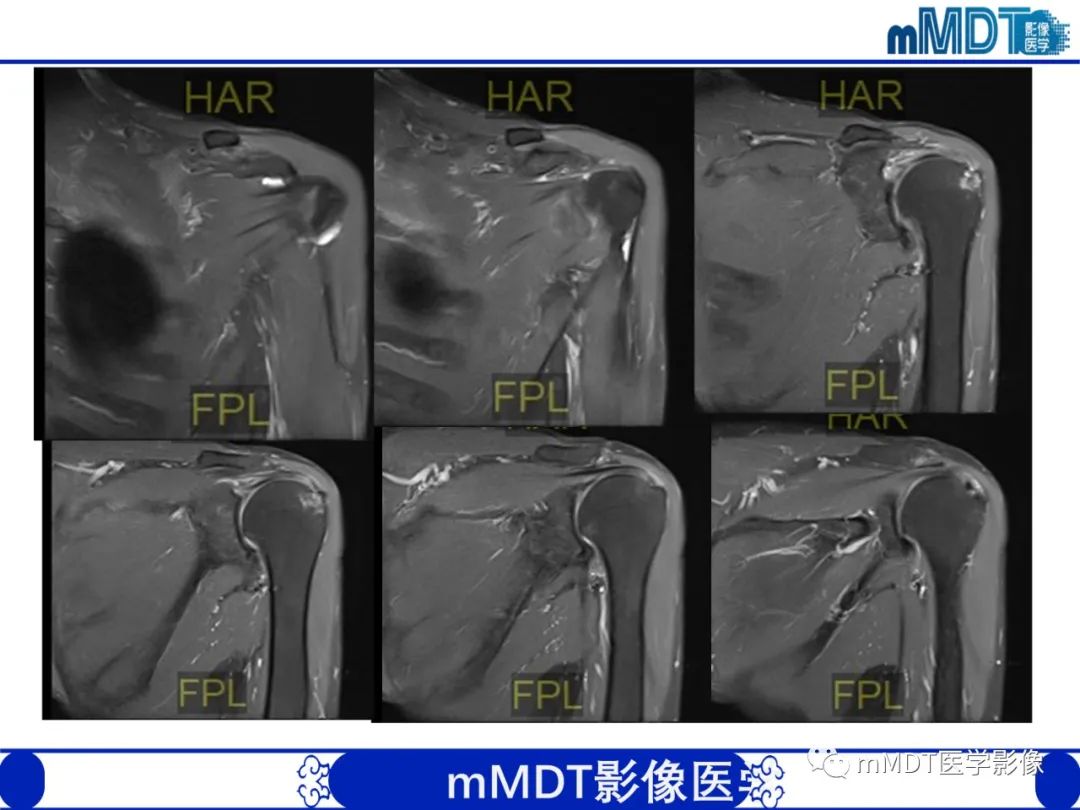 影像PPT - 【PPT】肩关节撞击综合征-1