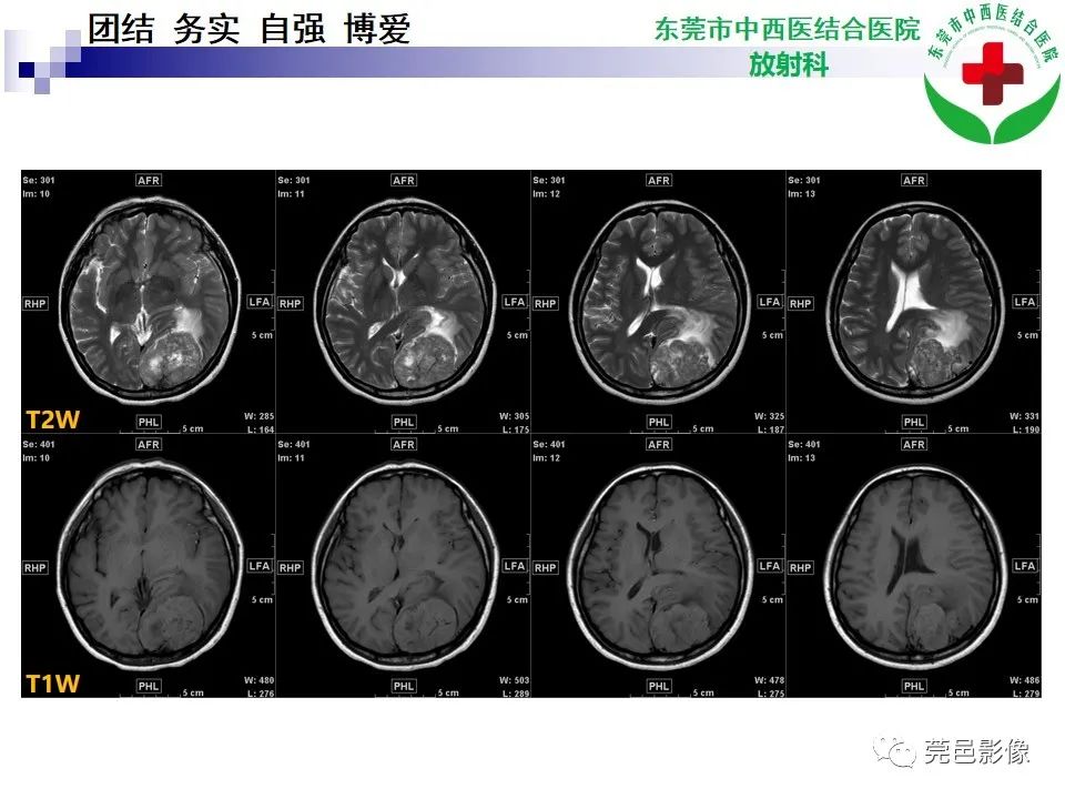 影像PPT - 【PPT】颅内孤立性纤维性肿瘤的影像诊断-5