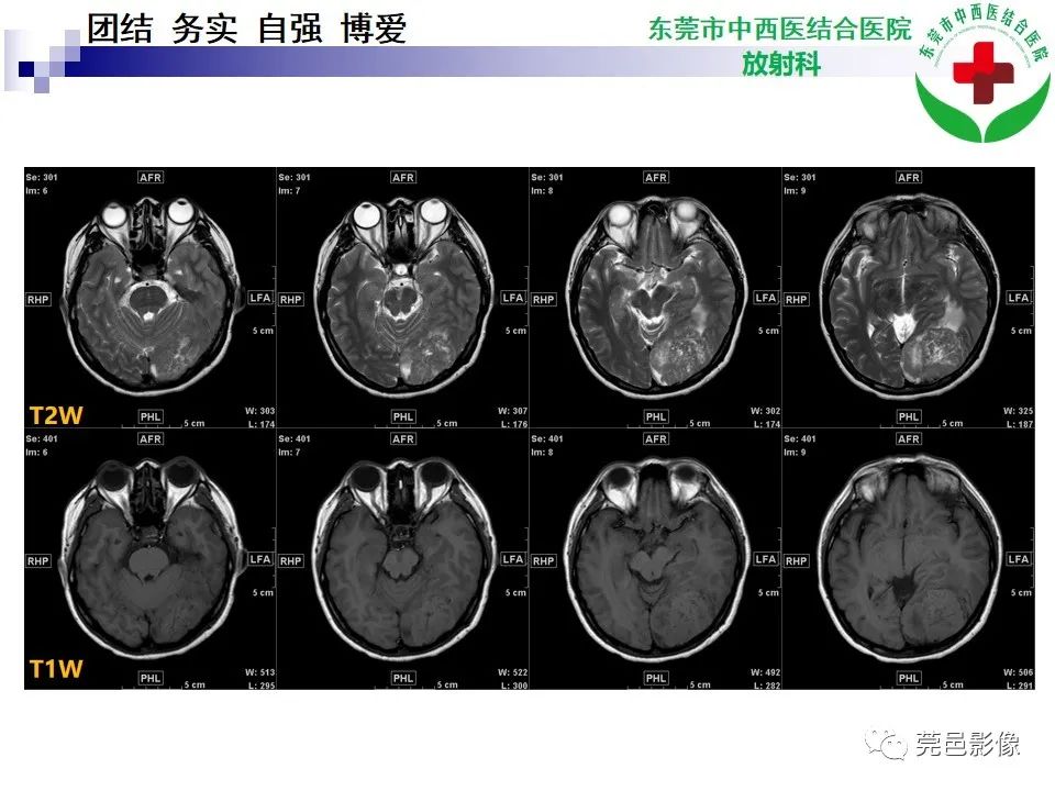 影像PPT - 【PPT】颅内孤立性纤维性肿瘤的影像诊断-4