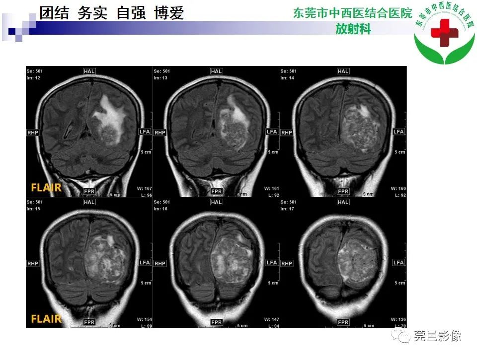 影像PPT - 【PPT】颅内孤立性纤维性肿瘤的影像诊断-6