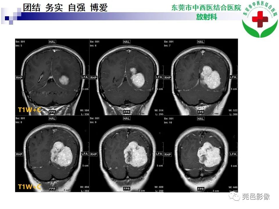 影像PPT - 【PPT】颅内孤立性纤维性肿瘤的影像诊断-8