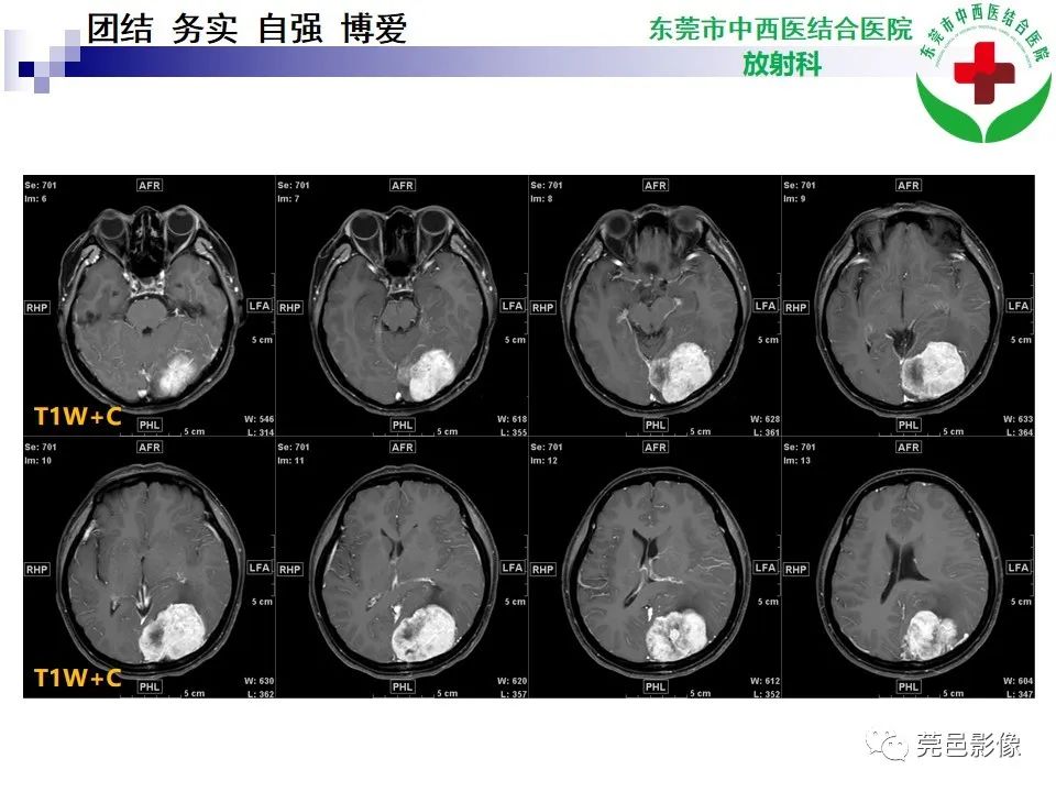 影像PPT - 【PPT】颅内孤立性纤维性肿瘤的影像诊断-7