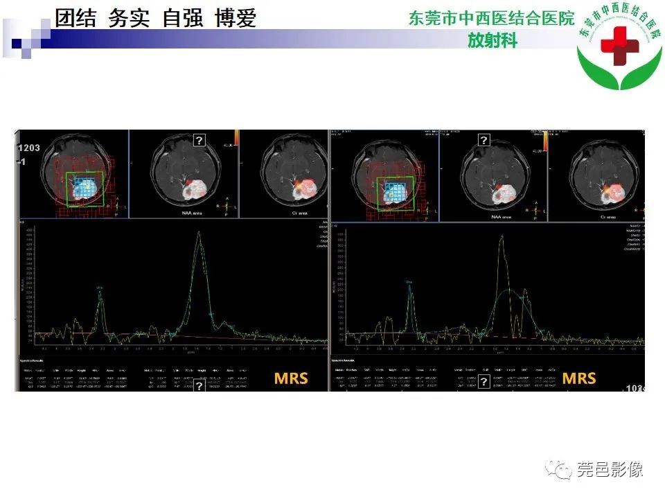 影像PPT - 【PPT】颅内孤立性纤维性肿瘤的影像诊断-10