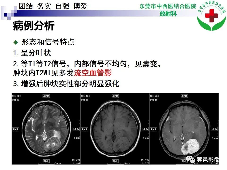 影像PPT - 【PPT】颅内孤立性纤维性肿瘤的影像诊断-13