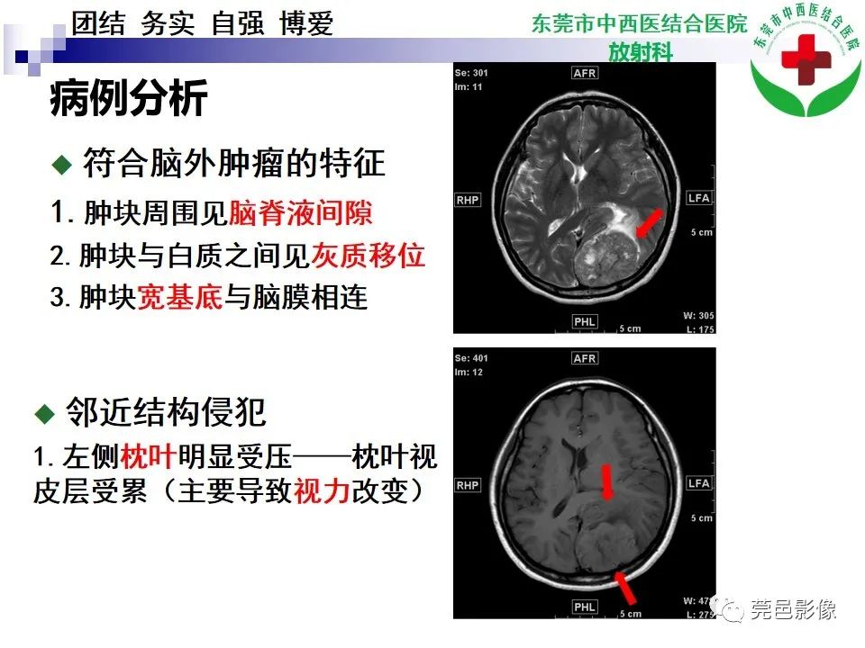 影像PPT - 【PPT】颅内孤立性纤维性肿瘤的影像诊断-12