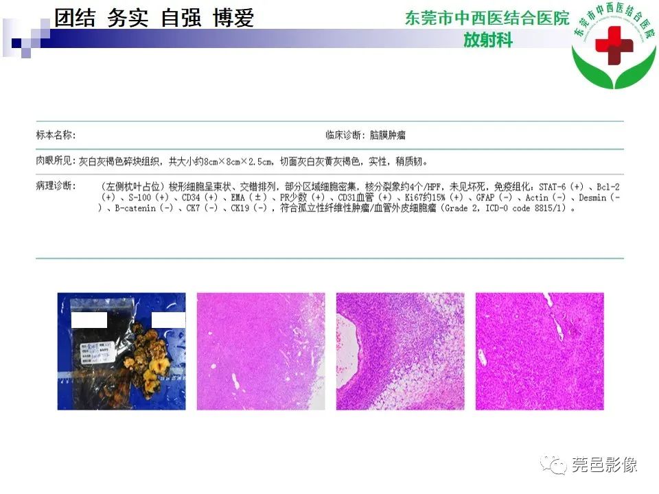 影像PPT - 【PPT】颅内孤立性纤维性肿瘤的影像诊断-14